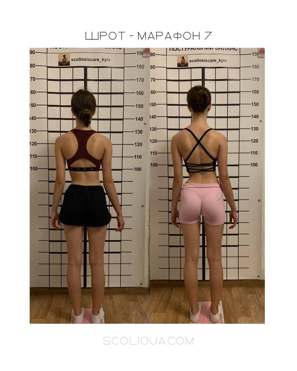 Schroth Therapy Result 3