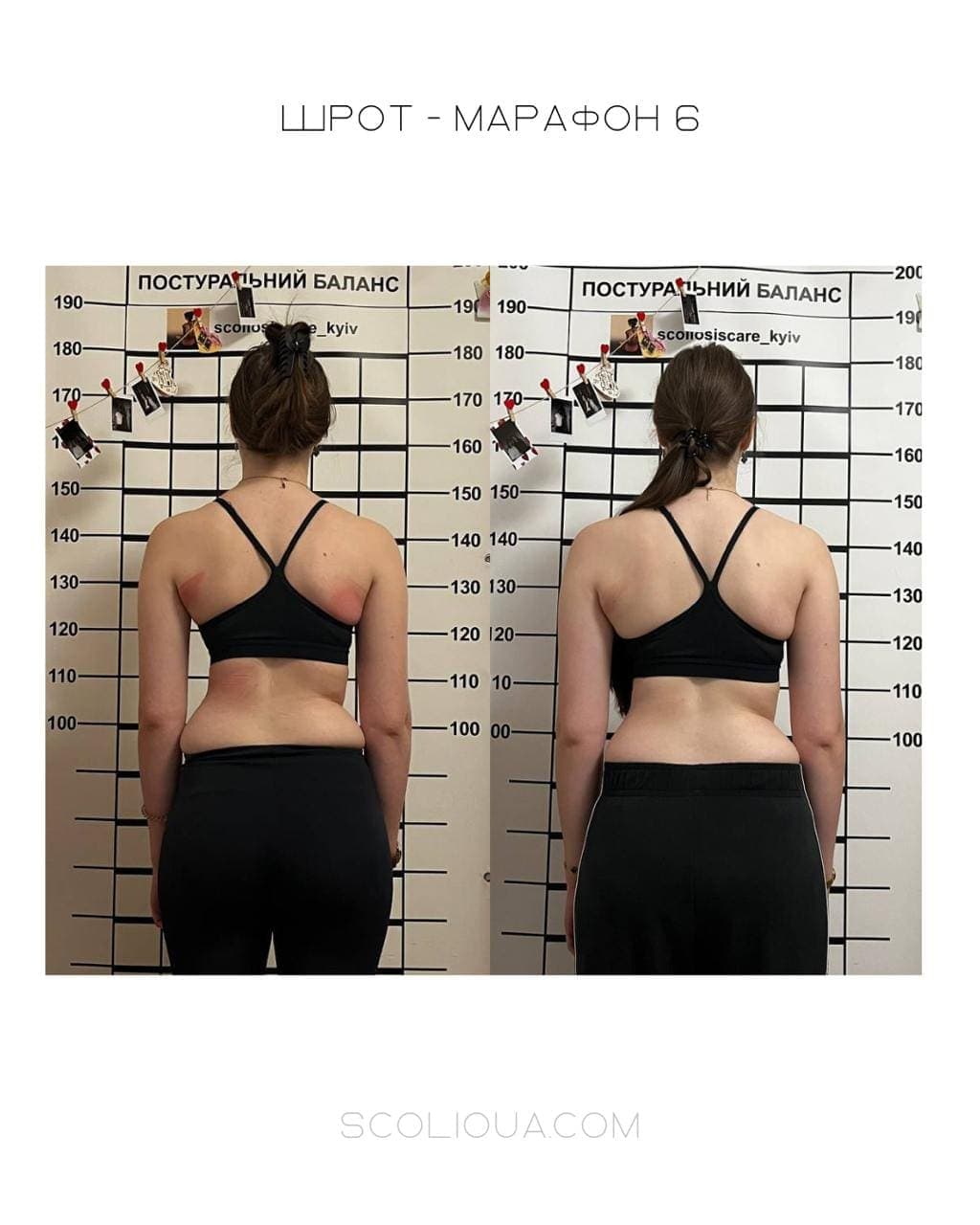 Schroth Therapy Result 5